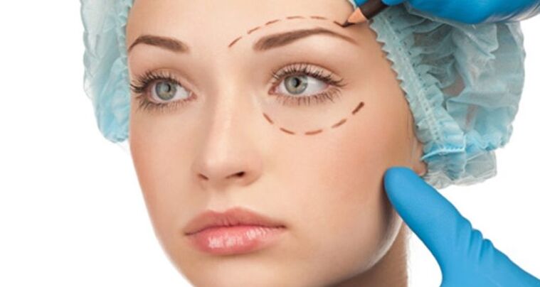 Lifting chirurgical