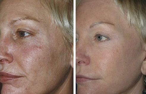 Rajeunissement fractionné au laser photos avant et après