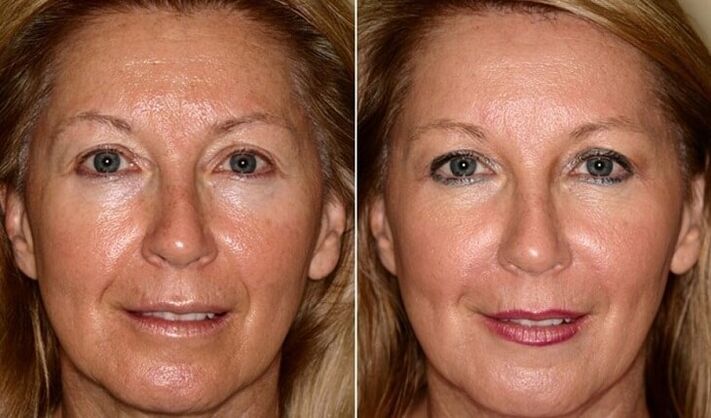 avant et après le rajeunissement de la peau du visage à la maison
