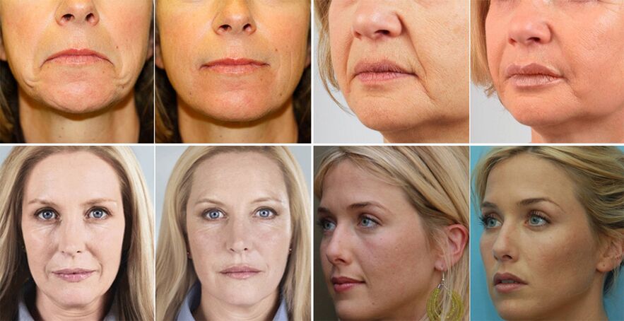 Photos de femmes avant et après le rajeunissement de la peau du visage