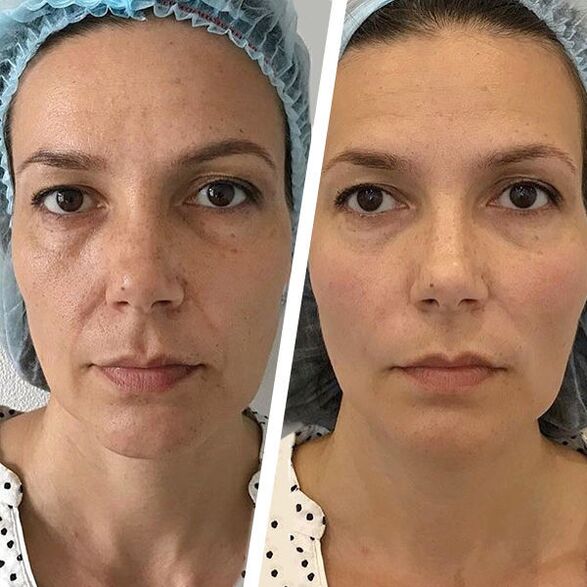 Photo de visage avant et après rajeunissement laser